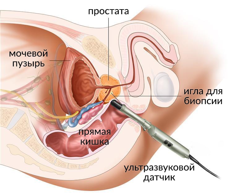 Биопсия рака простаты